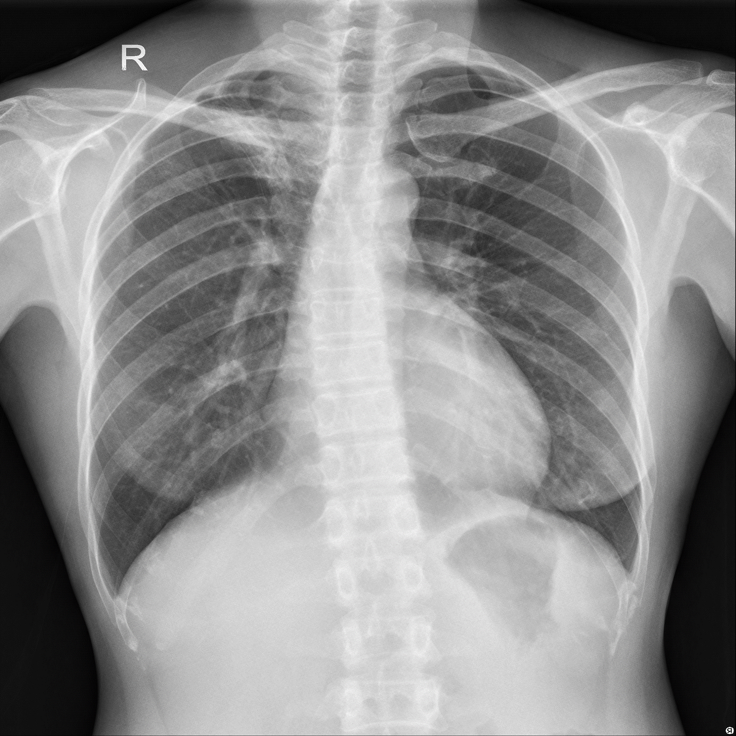 image-classification-tuberculosis-person